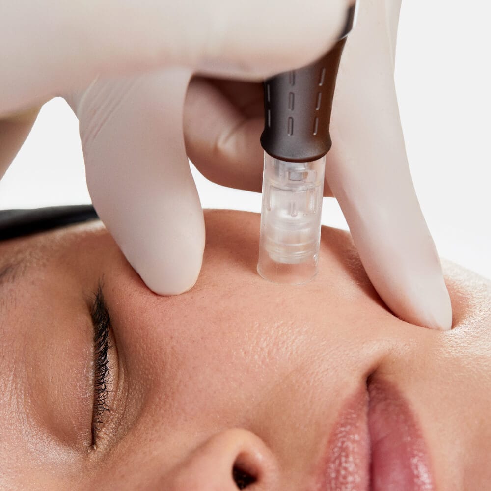 a person getting a facial injection, a pro nano infusion treatment